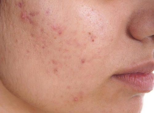 Camphor for acne