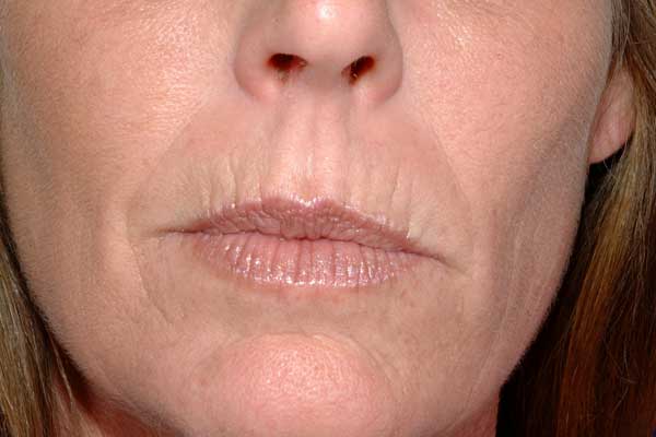 Home Remedies For Upper Lip Wrinkles 1