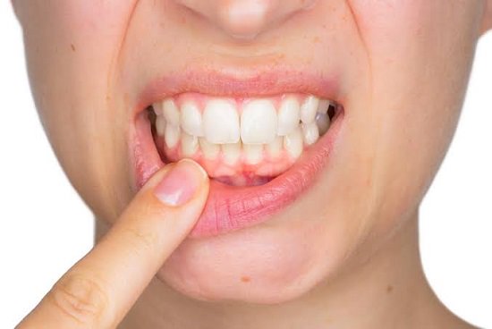 Home Remedies For Loose Teeth2