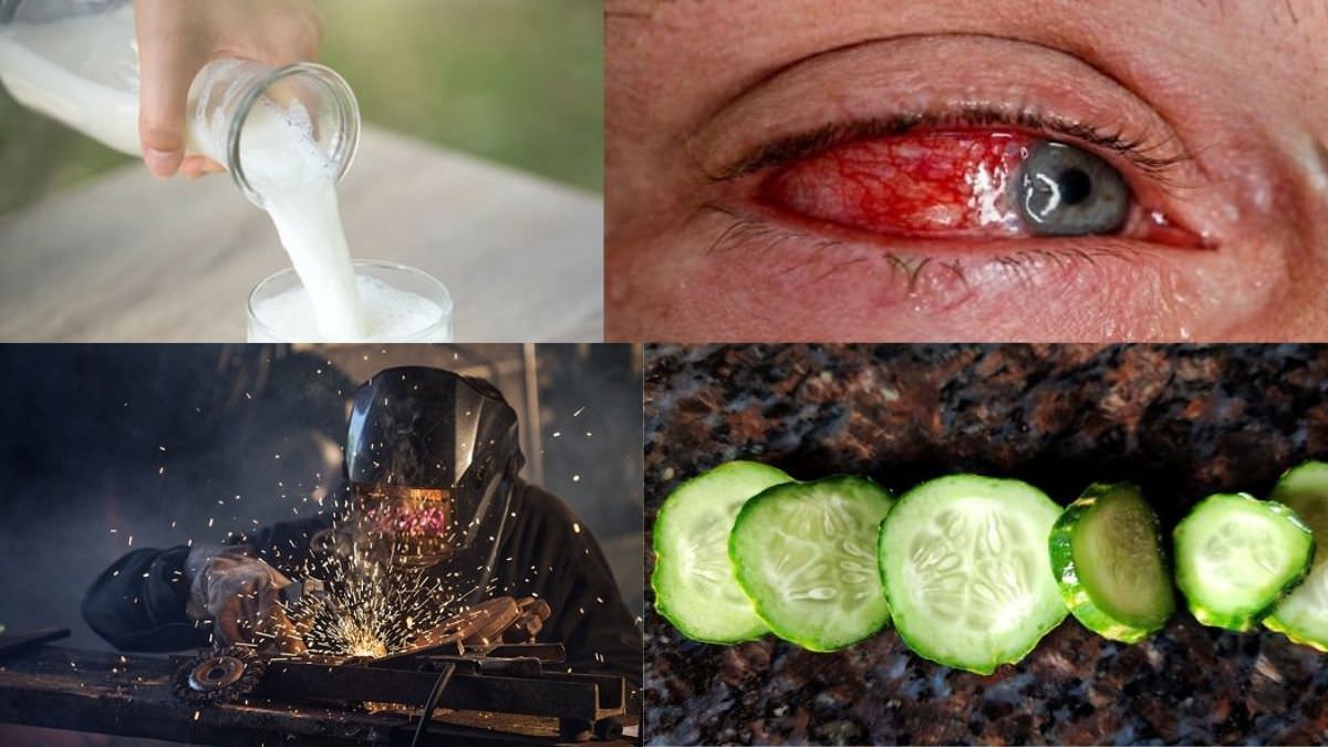 Welder’s Eye Burn Home Remedies + Treatment Suggestions