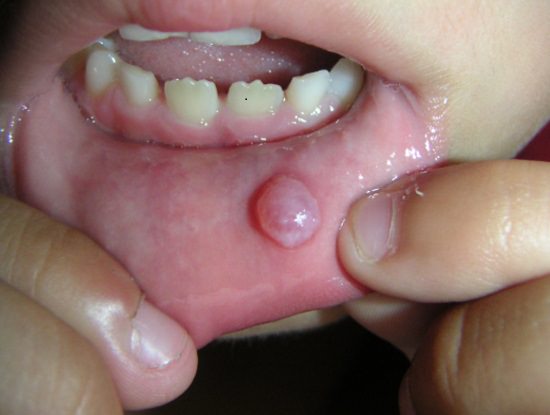 How To Cure A Mucocele At Home1
