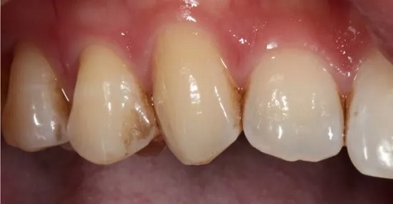 Tooth Cavity Vs a Stain1